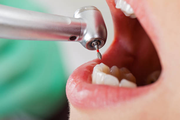 Best Root Canal Emergency Dentist  in Bellmead, TX